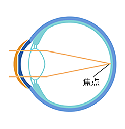 オルソケラトロジーレンズ装用中の角膜の状態の図