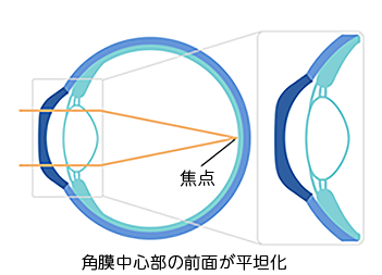 オルソケラトロジーレンズ装用後(裸眼時)の角膜の状態の図
