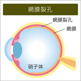 網膜裂孔のイメージ図