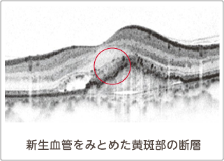新生血管をみとめた黄斑部の断層のOCT画像