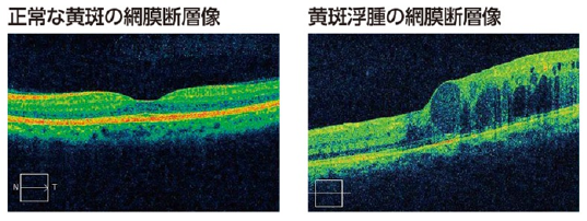正常な黄斑の網膜断層像と黄斑浮腫の網膜断層像